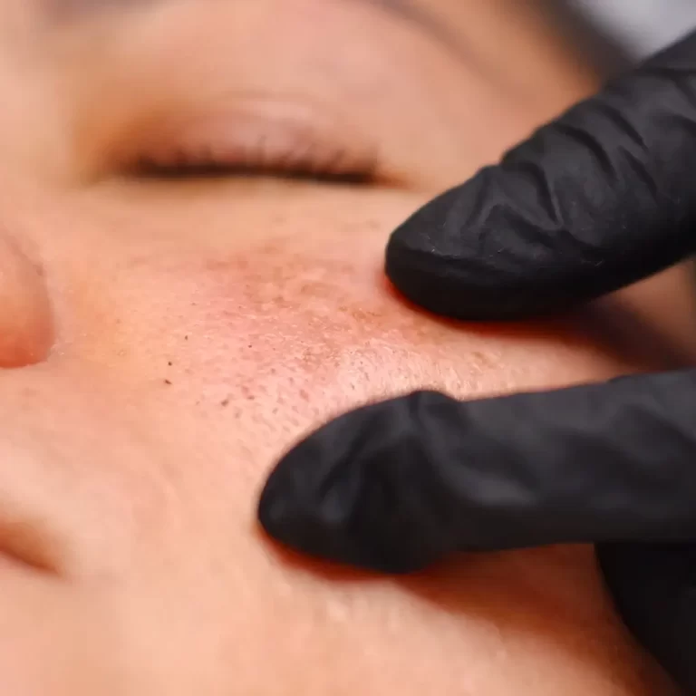 Laser para melasma o que realmente funciona e o que pode piorar 1920x1080_result